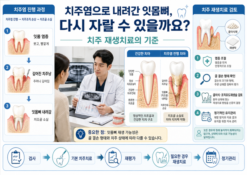 [생활건강] 치주염으로 잇몸뼈가 내려갔다는데 다시 자랄 수 있을까요? 치주 재생치료의 기....