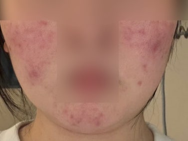 주사피부염 케토코나졸 연고 부작용 후기 ㅡ 테이퍼링이고 뭐고 다 그만하고 싶다.