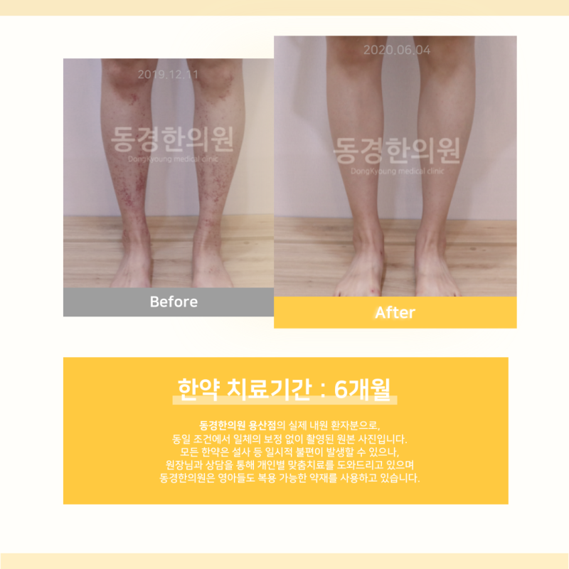 알레르기 자반증 연고로 해결될까? 한의사가 알려드립니다.