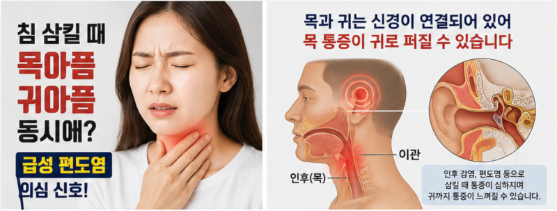 침 삼킬 때 목아픔·귀아픔 동시에? 단순 목감기 아닌 급성 편도염 의심 신호