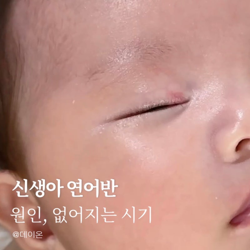 신생아 연어반 원인과 없어지는 시기, 아기 혈관종 차이점