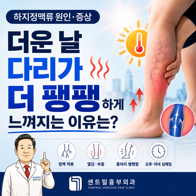하지정맥류 원인 증상 더운 날 다리가 더 팽팽하게 느껴지는 이유는?