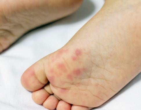 “발에 작은 물집이 여러 개 생겼다” 무좀·습진과 헷갈리기 쉬운 발 물집과 포진 구별 포인....