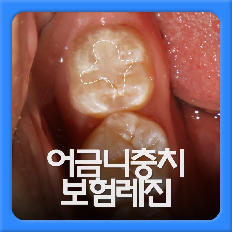 어금니 충치 레진 보험 적용 되나요?