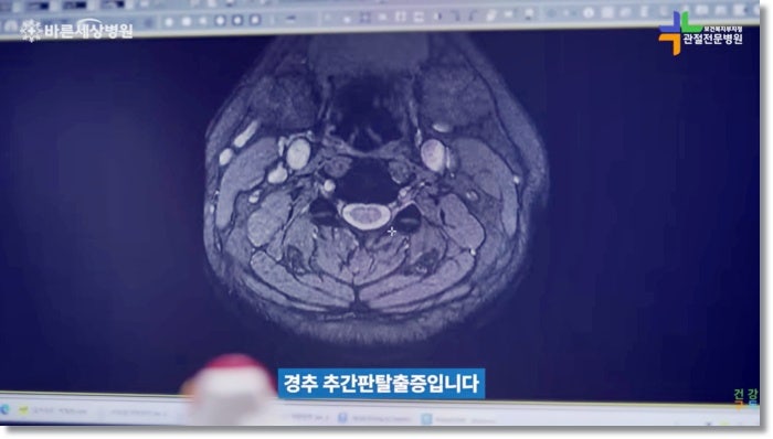 왼쪽 팔뚝 통증 원인 팔이 아프고 저린데 목디스크라고요?