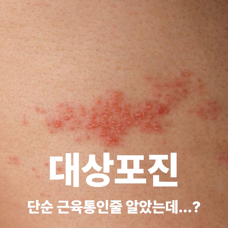 대상포진 초기증상 7가지, 원인부터 치료 예방법까지 알아보기