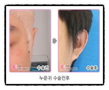 누운귀,누운귀수술 회복기간과 누운귀성형 후기입니다