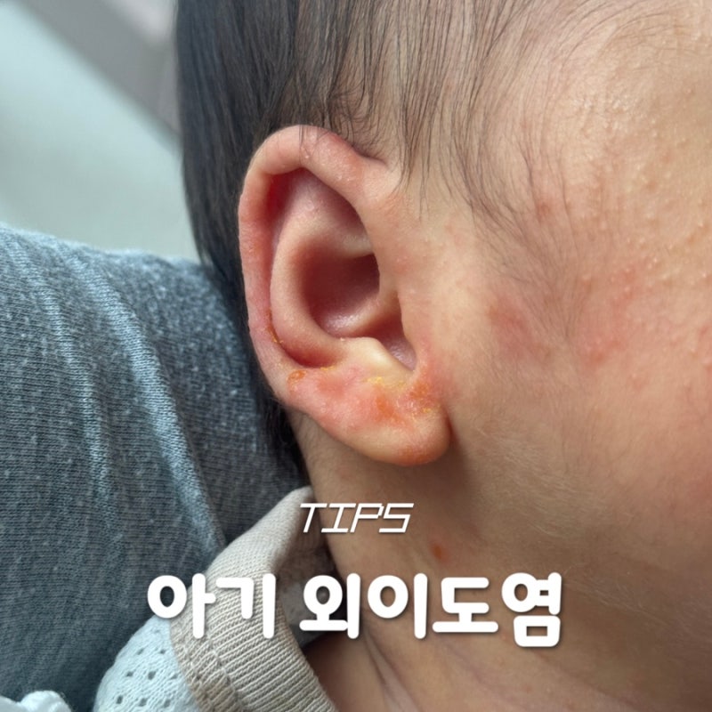 아기 외이도염 증상? 귀에 노란 진물 보여서 태열인 줄