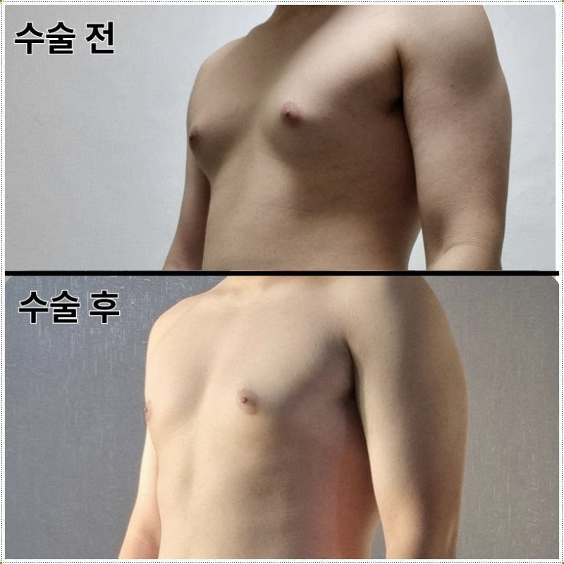 여성형유방증 치료방법 지방형과 유선형의 접근 차이 [Dr.디에이 여유증]