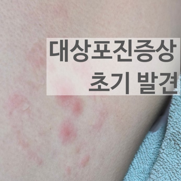 40대 남편 대상포진증상 초기 발견과 신경통 대처법