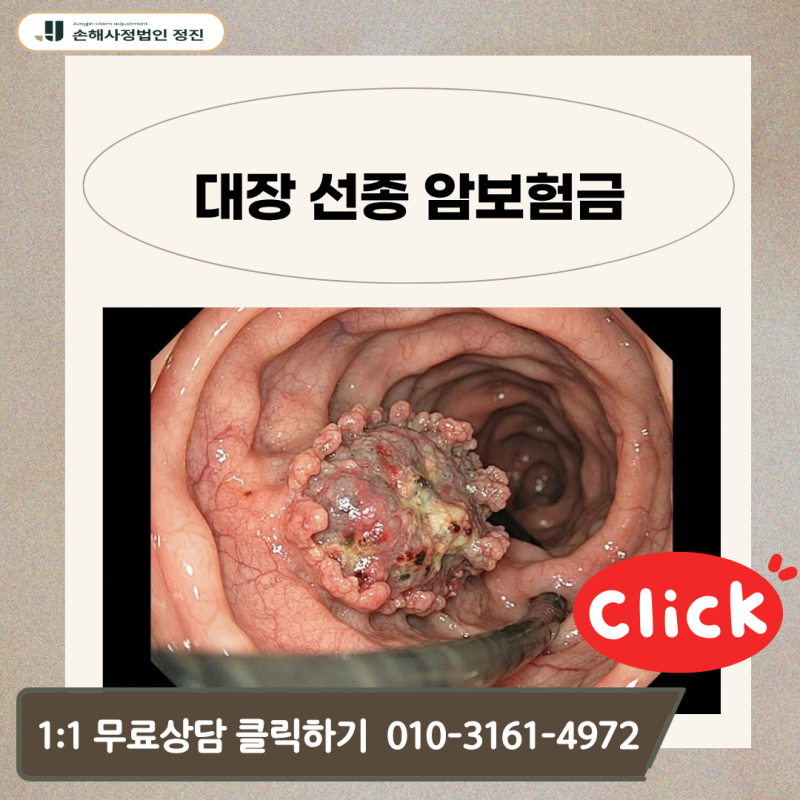 대장 선종 암보험금, D01·D12 코드 받고도 일반암 100% 수령이 가능할까?