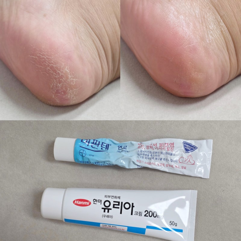 발뒤꿈치 각질 갈라짐 비판텐 연고 VS 한미 유리아 크림 비교