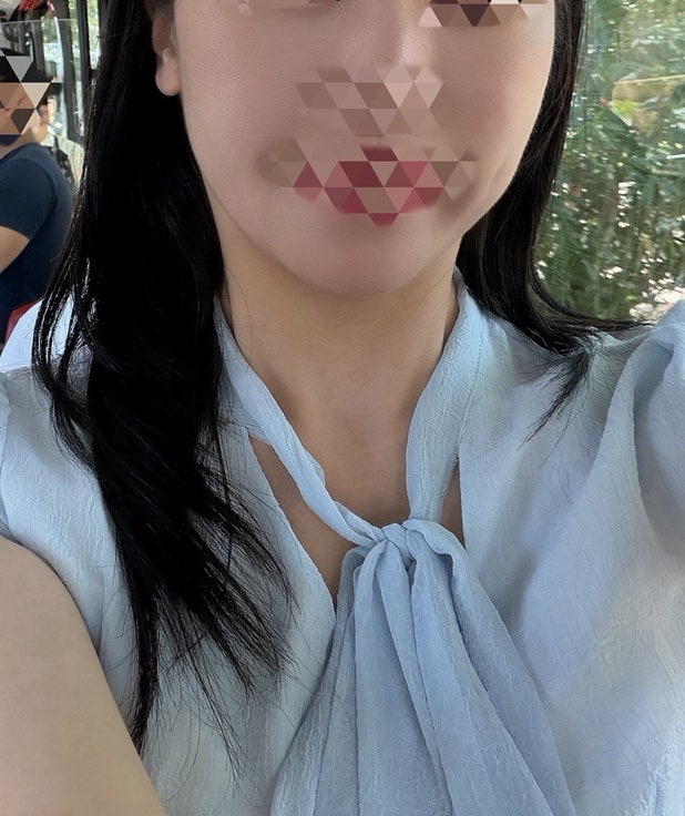 서울 편평사마귀 제거 성지 무제한 얼굴 후기(다운타임, 전후 비교 경과,주의사항)