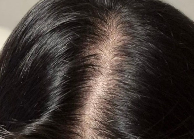 여성탈모치료제 종류 궁금했다면? 다들 이렇게 선택해요