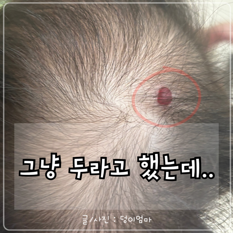 신생아 두피 빨간 반점, 연어반·혈관종·선천성모반? 그냥 지켜보다 후회한 이유