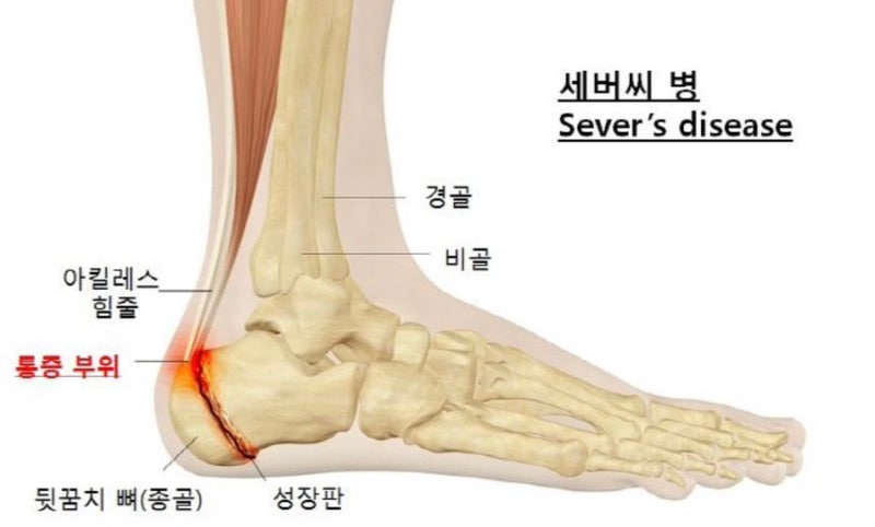 아이 발바닥 통증 원인? 9살 아이 종골골단염(세버병) 진단 후기
