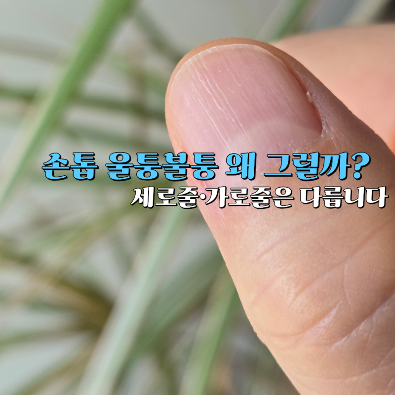 손톱 울퉁불퉁 그냥 넘겼다면? 세로줄·가로줄은 다르게 봐야 합니다
