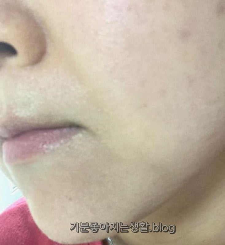 고우리 스킨부스터 팔자주름 가격 효과 전 후 리얼후기 홈케어 진짜 중요!!
