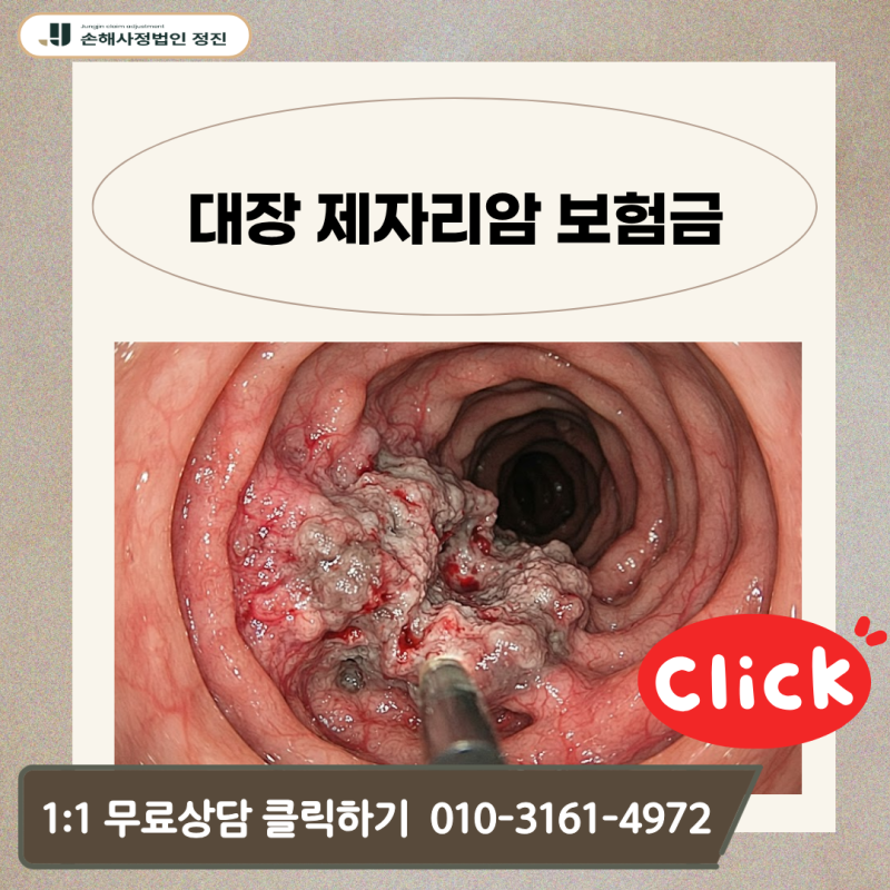 대장 제자리암 보험금, D01 코드 받고도 일반암 전액 수령이 가능할까?