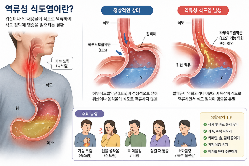 역류성 식도염 증상부터 원인, 치료방법, 좋은 음식과 영양제까지 한눈에 정리