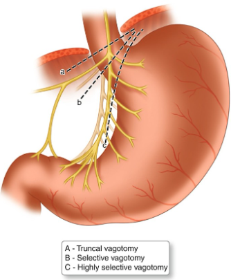 [위장관] 위궤양의 외과적 치료 (Gastric ulcer treatment)