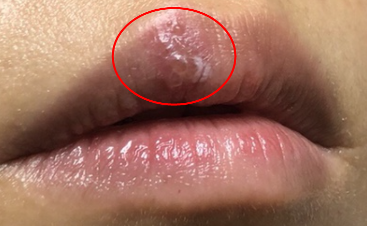 구순포진 입술 헤르페스 원인 재발 이유 아시클로버 연고 사용 시점 총정리