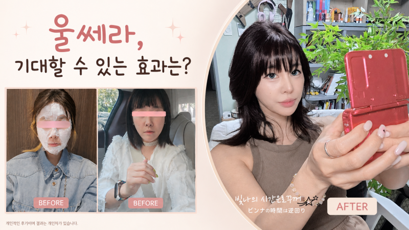 울쎄라 수면마취 리얼후기, 30대 후반 팔자주름 리프팅 효과와 시술주기