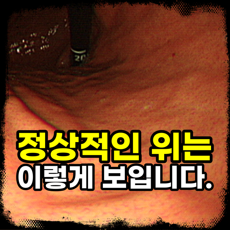 위선종 제거했는데 위암? 조직검사 결과가 달라지는 이유