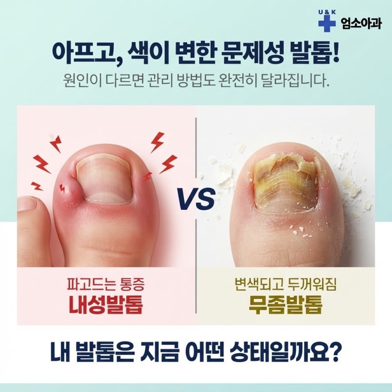 일산동 문제성발톱, 내성발톱과 무좀발톱 함께 알아보기