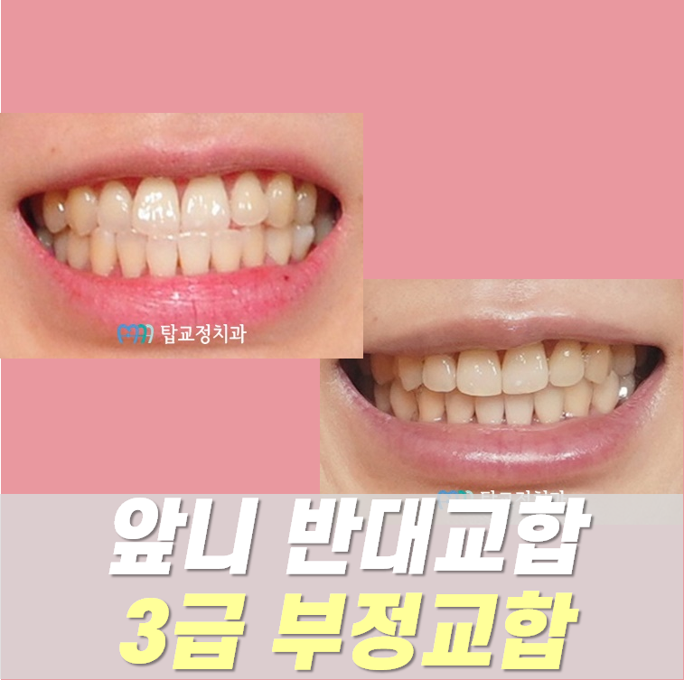 광주치아교정 치료사례로 설명, 3급 부정교합, 앞니 반대교합