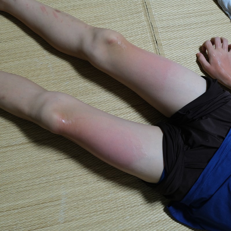 물놀이 일광화상 1도 2도 화상연고 비아핀 피부 통증 가려움 대처법
