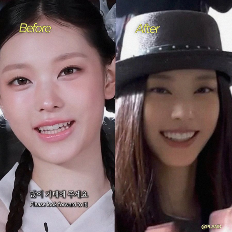 뉴진스 해린 치아 변화 라미네이트 논란, 송곳니의 진실은?