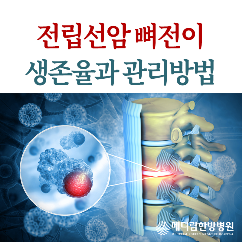 전립선암 뼈전이 치료, 4기 생존율과 관리