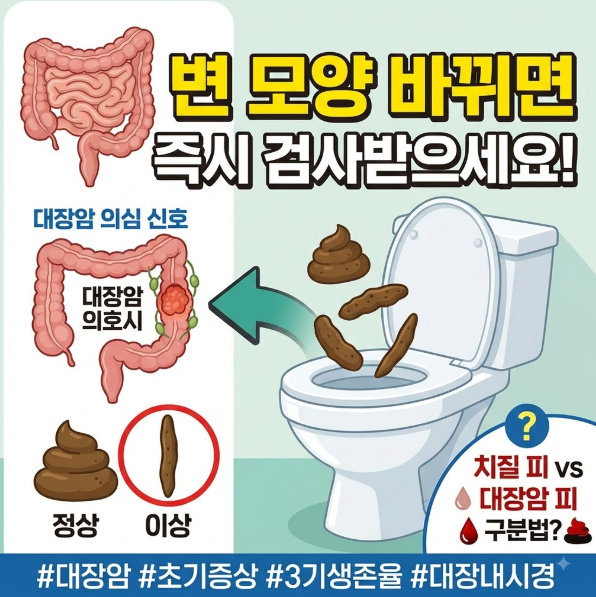 변 모양이 이렇게 바뀌면 검사받으세요! 대장암 초기 증상부터 3기 생존율, 치질 피 구분법까....