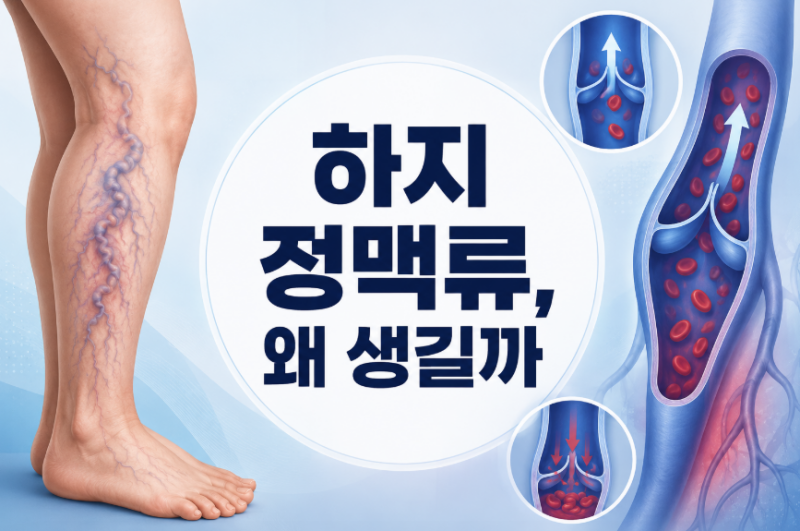하지정맥류는 왜 생길까? 원인·증상·진단·치료 방법 총정리