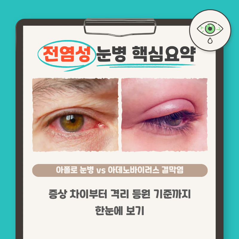 아폴로 눈병·아데노바이러스 결막염 차이? 전염성 안질환 유행시기·증상·격리 기간·치료 ....