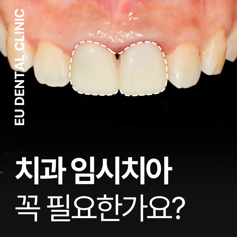 앞니 임시치아 빠짐 통증 삼킴 대처법, 기간 꼭 필요한가요?