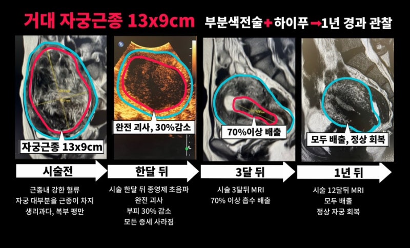 거대 자궁근종 13cm, 수술 없이 근치적 치료
