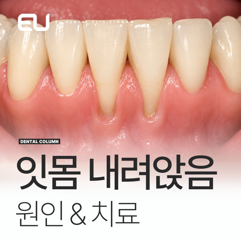 잇몸 내려앉음 퇴축 통증 원인, 약으로 치료되나요?