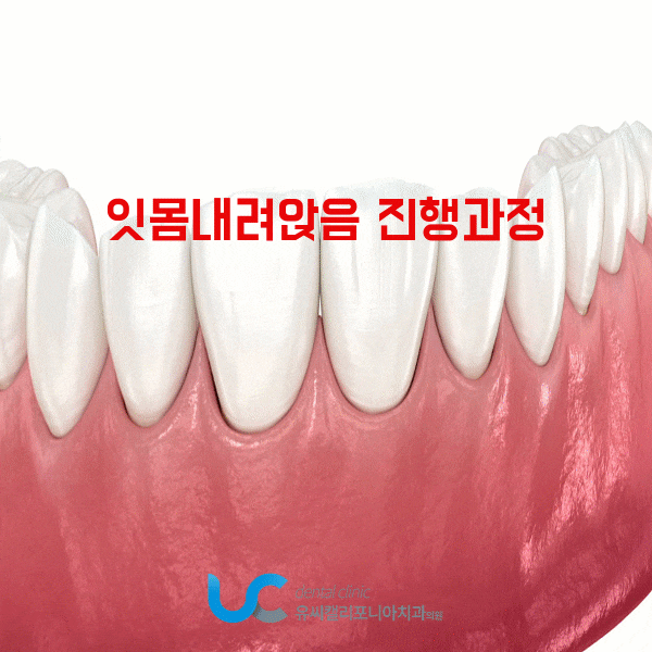 잇몸내려앉음 상태가 임플란트 까지 이어질 수 있다구요?