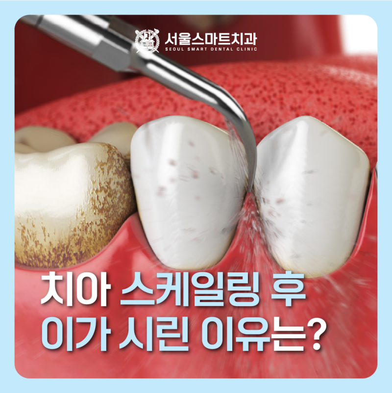 송도 치과 치아 스케일링 후 이가 시린 이유는?
