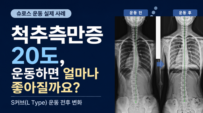 척추측만증 20도, 운동하면 몇 도까지 좋아질까요?｜슈로스 운동 전후 X-ray 사례