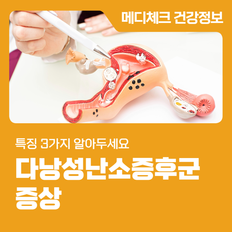 다낭성난소증후군 증상 특징 3가지 알아두세요