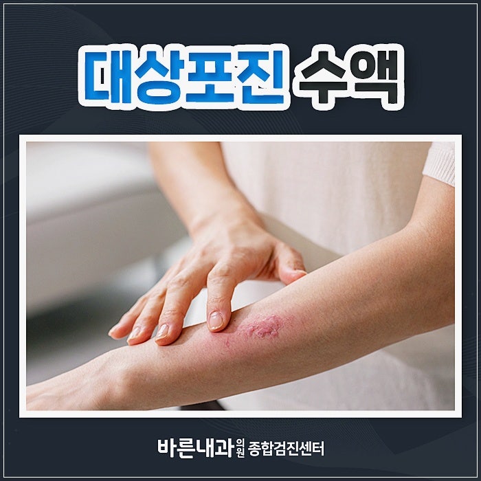 대상포진 수액, 어떤 효과가 있을까요?