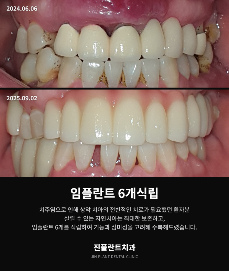 의정부수면치과 ,치과가 무서워서 10년 미룬 분들께