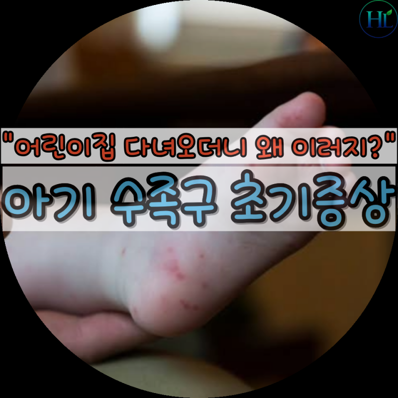 "열감기와 뭐가 다를까?" 부모가 알아둘 아기 수족구 초기증상