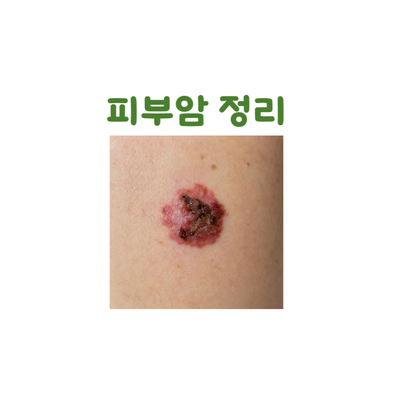 피부암의 발생원인 종류 그리고 치료 방법 그리고 진단시 우리가 해야 할 것들