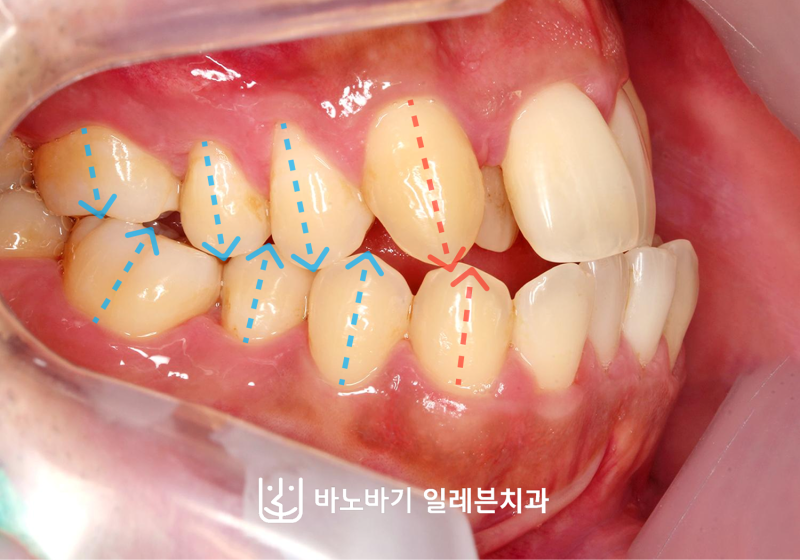 주걱턱 부정교합 심한데 비발치로 교정한다고요?
