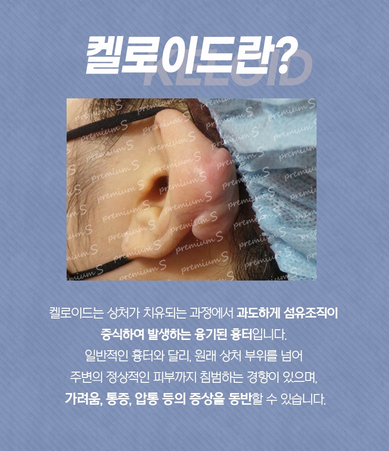 부산귀켈로이드치료는 언제까지 병원에 다녀야 할까요?