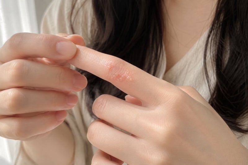 손가락 한포진 수포 증상과 관리법, 작은 물집 그냥 터뜨려도 될까?
